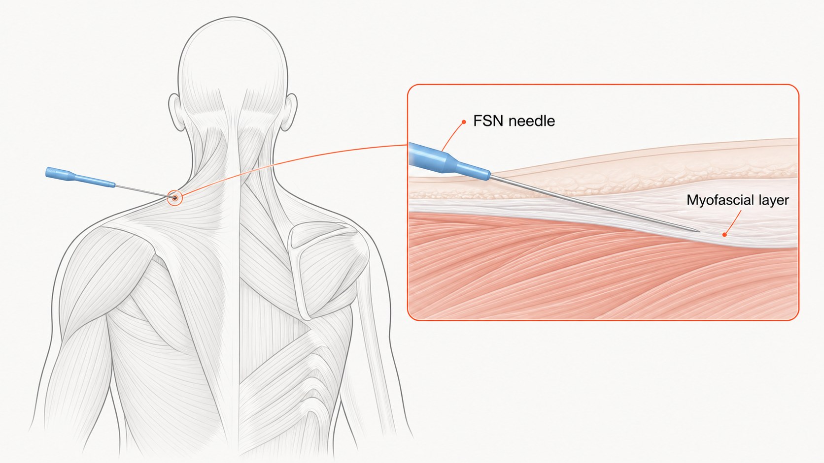 FSN needle entering the myofascial layer at a shallow angle
